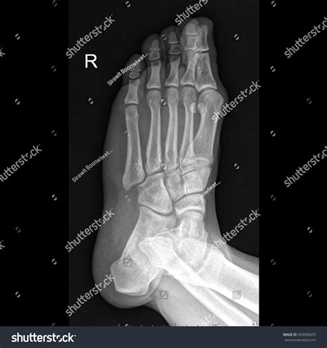 Foot Oblique View