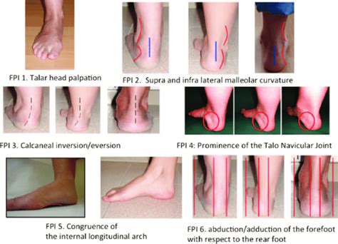 Foot Posture Index