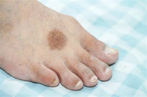 Foot Somination