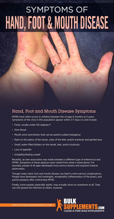 Foot-and-mouth disease: prevention and preparedness