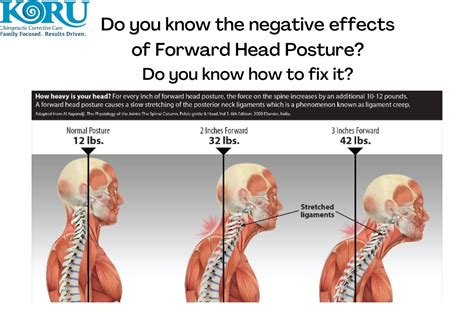 Forward Head Posture Correction Posture Direct
