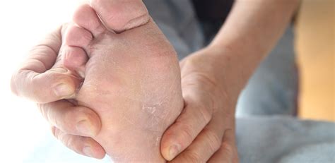 fotsvamp på hela foten