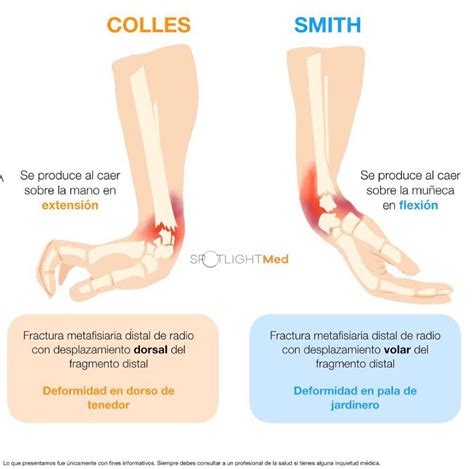 Fractura De Colles