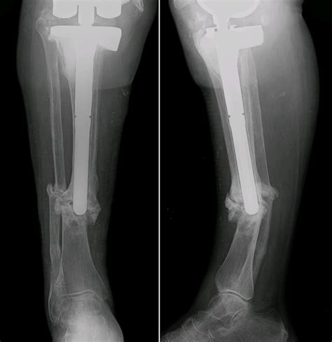 Fractura Tibia Y Perone