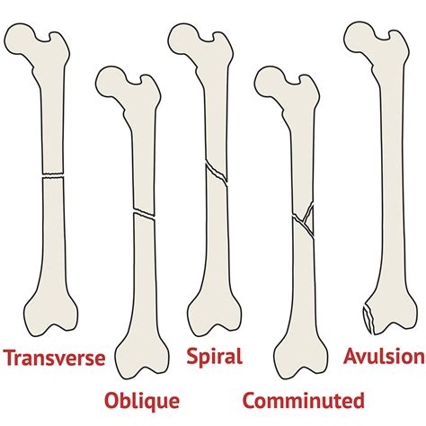 Fracture