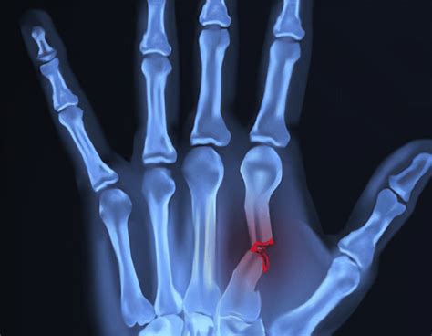 Fractures Of The Hand And Carpus Fessh 2018 Instr