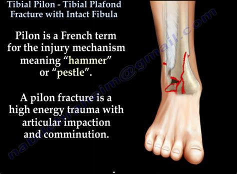 Fractures Of The Tibial Pilon