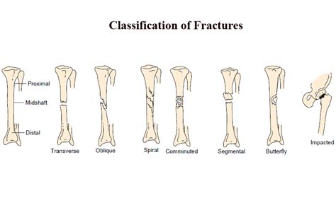 Fractures Types Of Bone Fractures Worksheet - Types Of Bone Fractures Worksheet