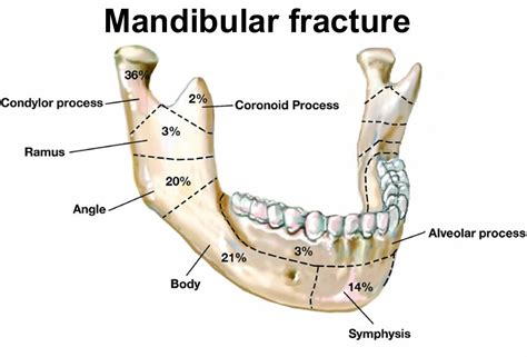 Download Fractures Of The Mandible 