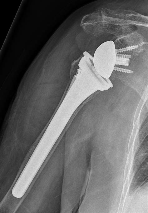 fractuur na prothese