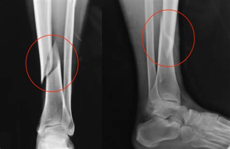 Fratura Da Tibia