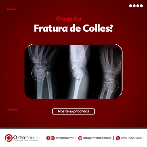 Fratura De Colles