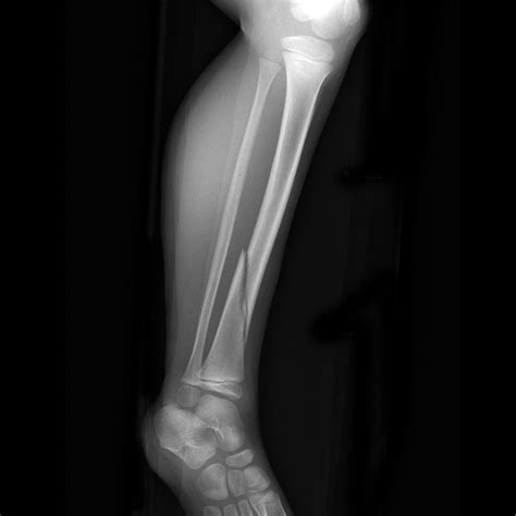 Fratura Na Tibia