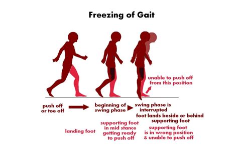 freezing of gait