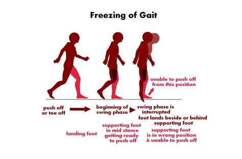 Freezing Of Gait Overview On Etiology Treatment And Frozen Science - Frozen Science
