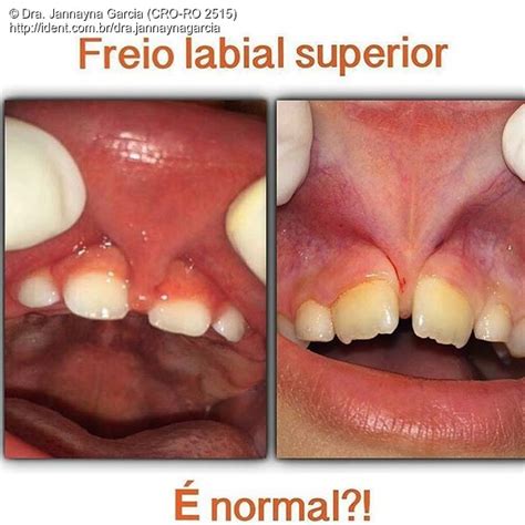 Freio Labial Superior