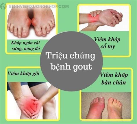 gút | Bnh gt Gout l g Triu chng