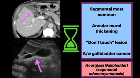 gallbladder adenomyomatosis 뜻