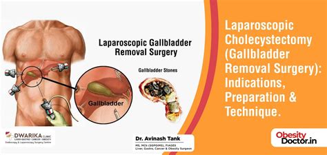 Gallbladder Removal Icd 10