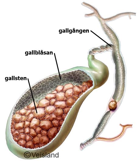 gallsten symtom