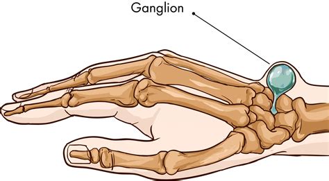 ganglion - metilprednisolona inyectable