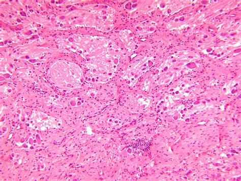 ganglioneuroblastoma intermixed