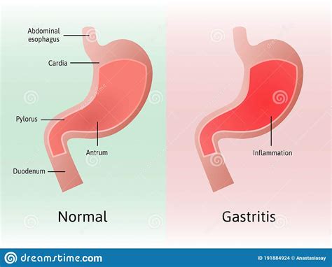 gastritis-1