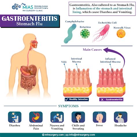 gastroenteritis 2024