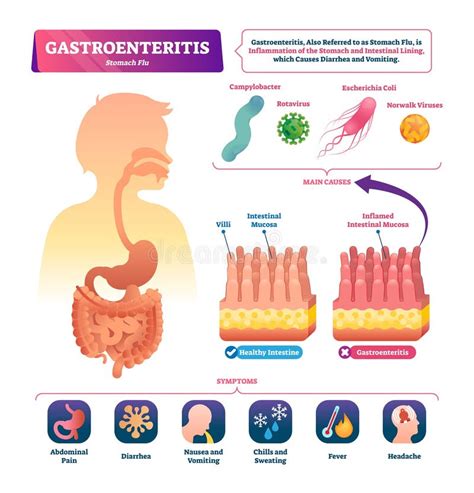 gastroenteritis-4