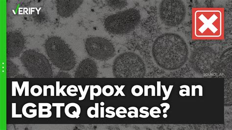 gay monkepox