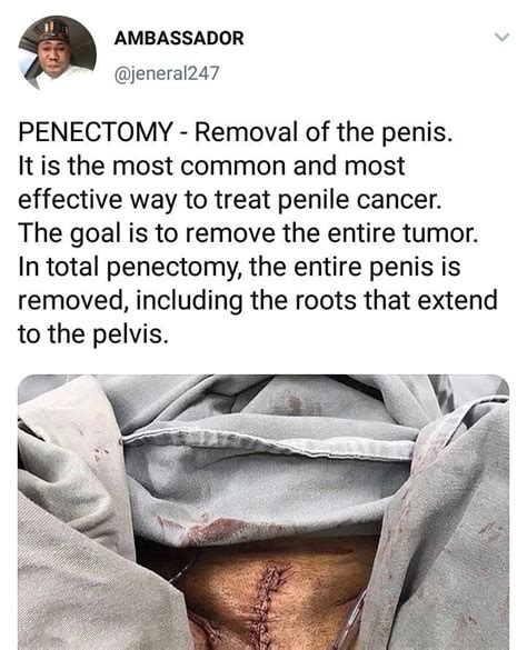 Gay penectomy