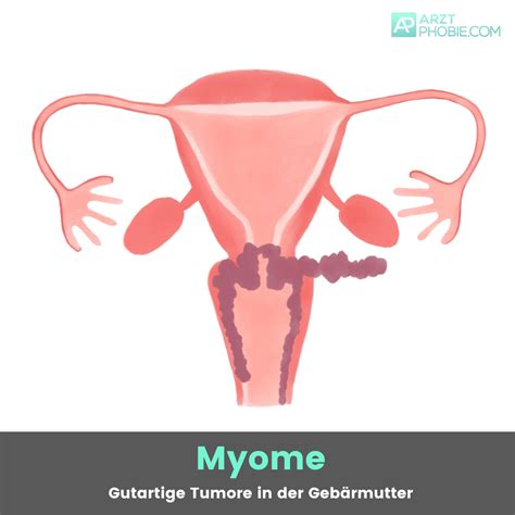 gebärmutter dicker bauch