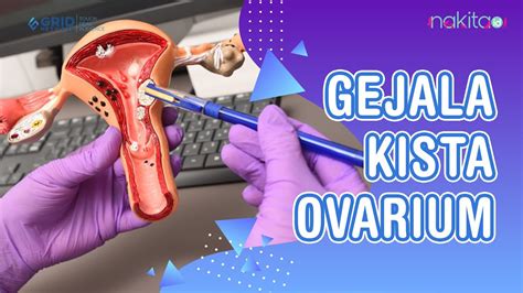gejala kista ovarium