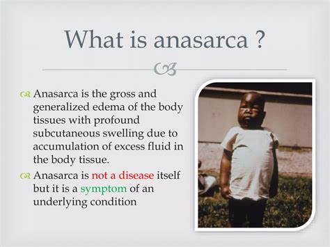 Generalized Edema Anasarca