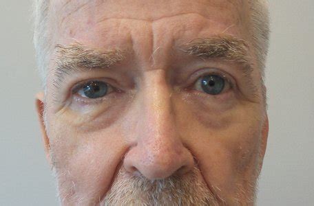 gezichtsveldbeperking