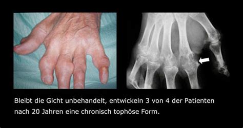 gicht chronisch