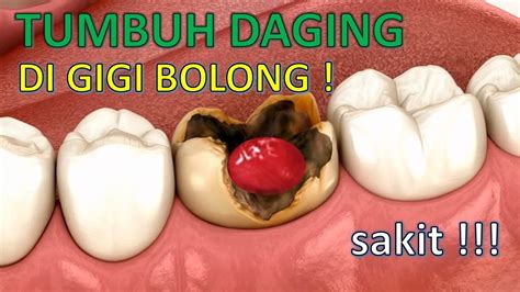 GIGI BERLUBANG TUMBUH DAGING - Gigi Berlubang Tumbuh Daging