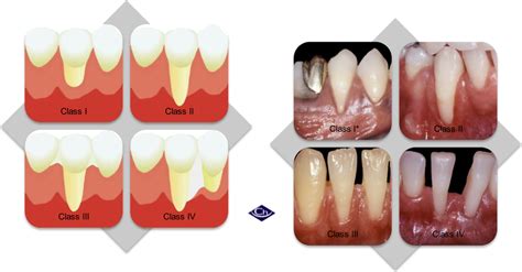 Gingival Recession Classification