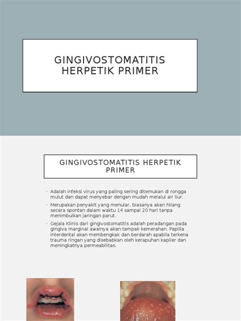 gingivostomatitis herpetic primer pdf