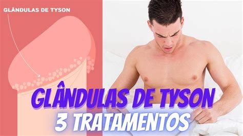 Glandulas De Tyson