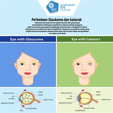 glaukoma dan katarak