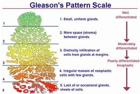 Gleason Scoring System