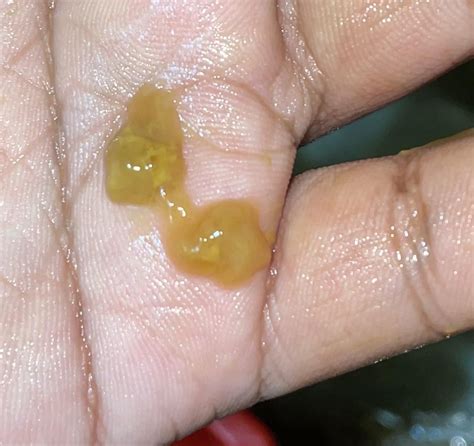 gooey stuff in poop