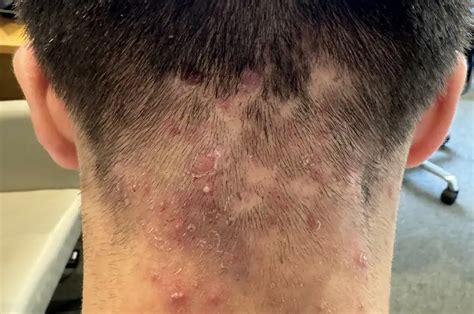 Gram Negative Folliculitis