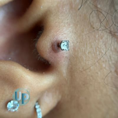 Granuloma From Piercing