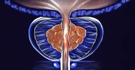 green light laser prostate ablation