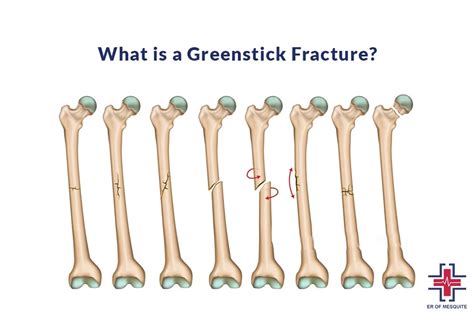 Greenstick Bone Fracture