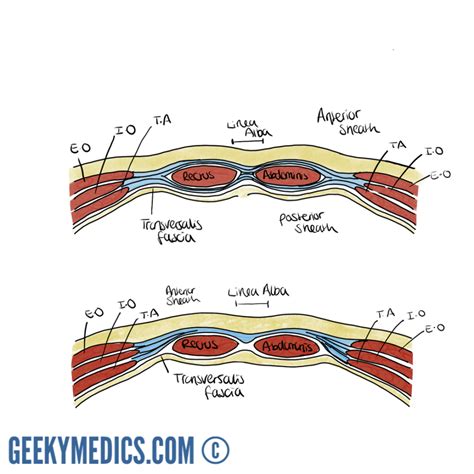 Grid Iron Incision