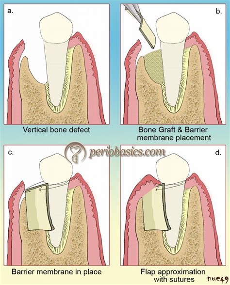 Guided Bone Regeneration