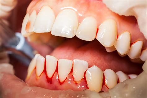 gum bleeds in one spot when flossing